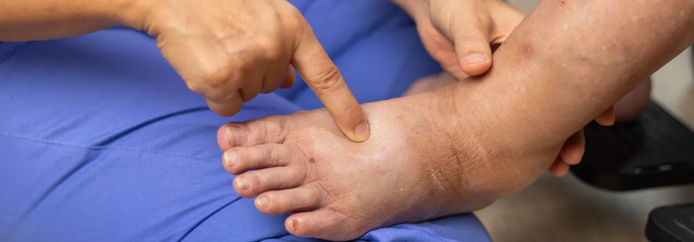 Diabetischer Fuß Pflege: Wann Podologie medizinisch notwendig wird Diabetischer Fuß Pflege: Wann Podologie medizinisch notwendig wird