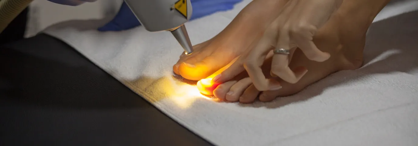 Laserbehandlung Nagelpilz: Wirksamkeit, Kosten & Therapie-Erfolg Laserbehandlung Nagelpilz: Wirksamkeit, Kosten & Therapie-Erfolg